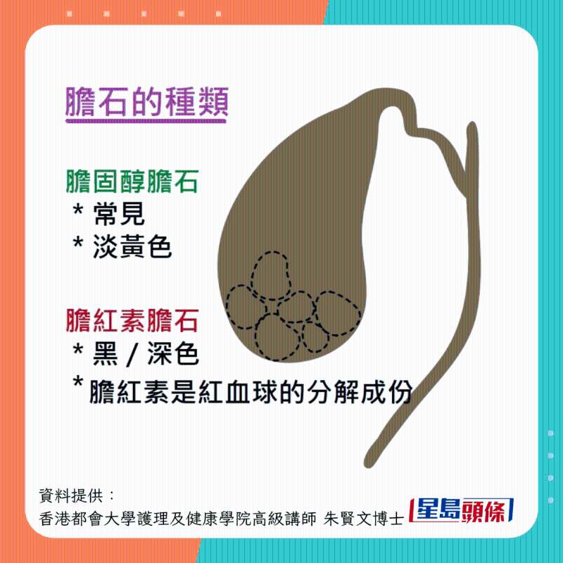 膽結(jié)石種類