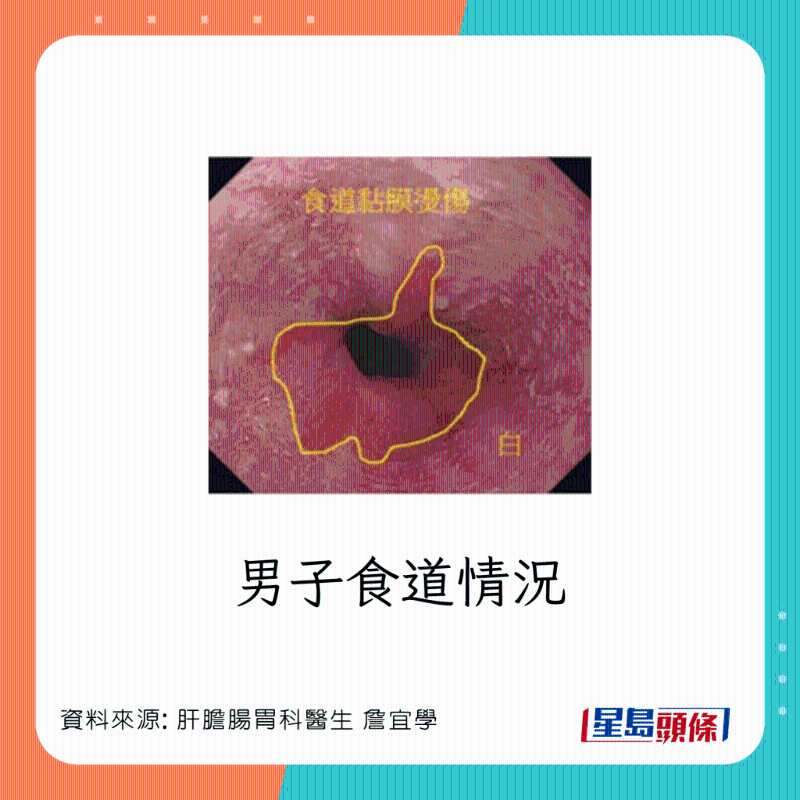 男患者食道灼傷，可惡化成食道癌
