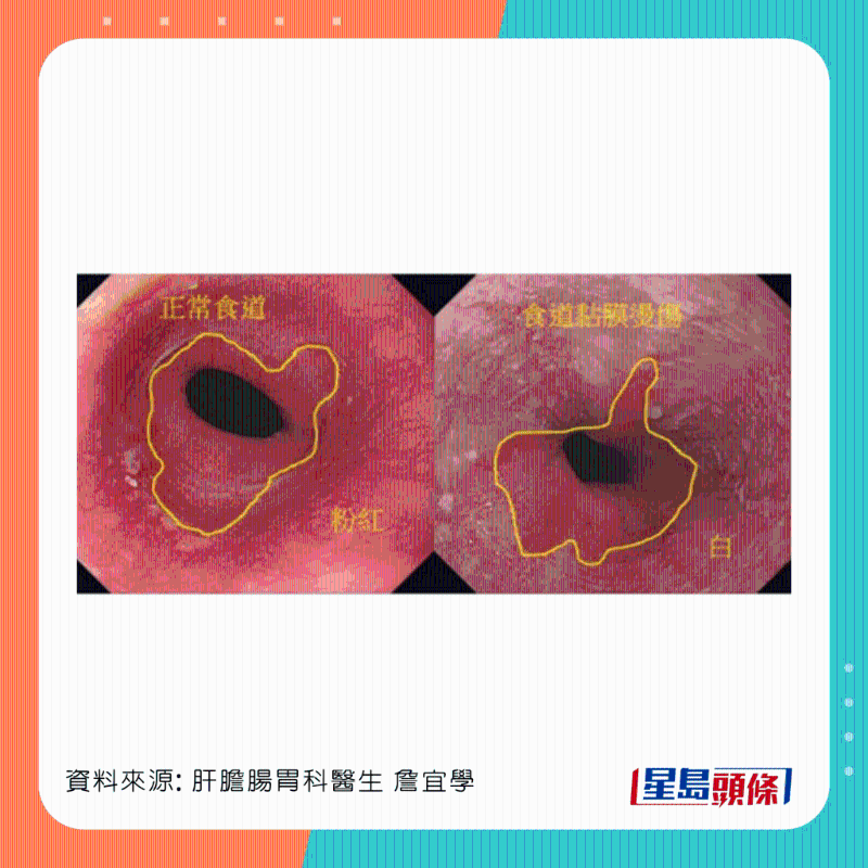 男患者食道灼傷，可惡化成食道癌