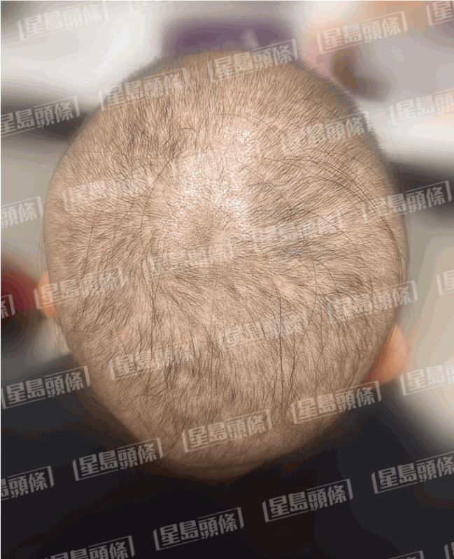 脫髮女子治療一個星期後的進(jìn)度。（相片由註冊中醫(yī)師陳嬿珺提供）