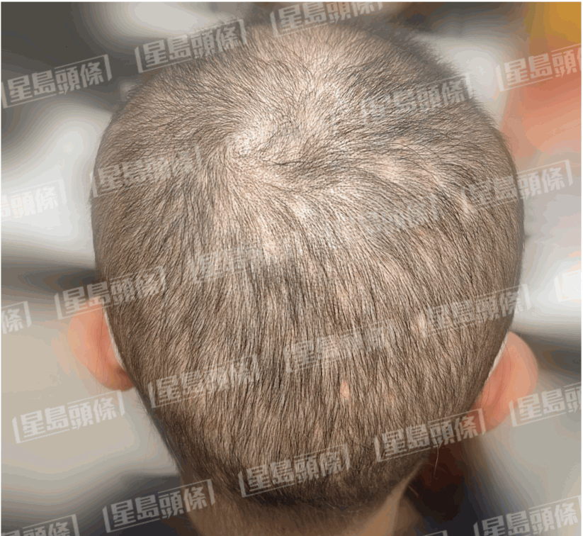 脫髮女子治療兩個星期後的進(jìn)度。（相片由註冊中醫(yī)師陳嬿珺提供）