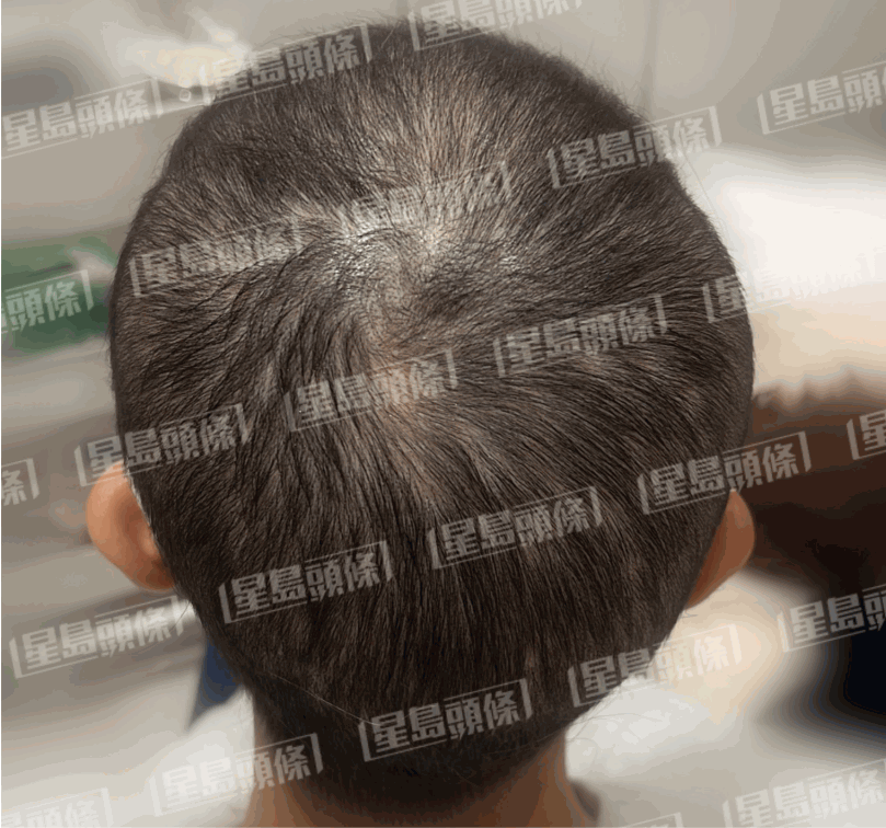 脫髮女子治療三個星期後的進(jìn)度，頭髮亦慢慢開始生長。（相片由註冊中醫(yī)師陳嬿珺提供）