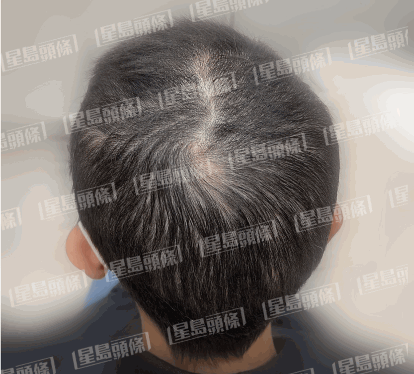 脫髮女子治療一個月後的進(jìn)度，重新長回濃密頭髮，禿頭消失，回復(fù)健康。（相片由註冊中醫(yī)師陳嬿珺提供）