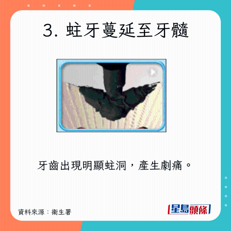 蛀牙癥狀及治療方法