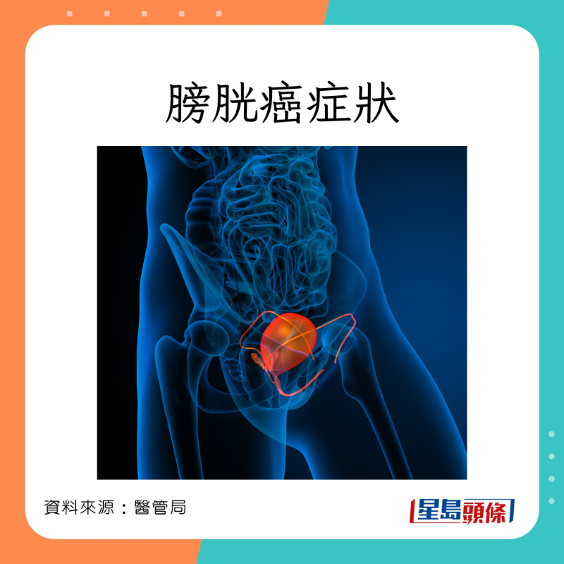 醫(yī)管局分享膀胱癌的癥狀。