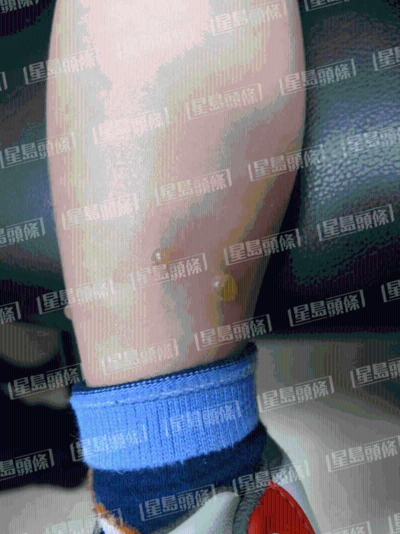 蚊叮蟲咬｜5歲患者被蚊蟲叮咬后長(zhǎng)出水泡，最終出現(xiàn)疤痕組織增生長(zhǎng)出肉芽。（相片來(lái)源：陳厚毅醫(yī)生提供）