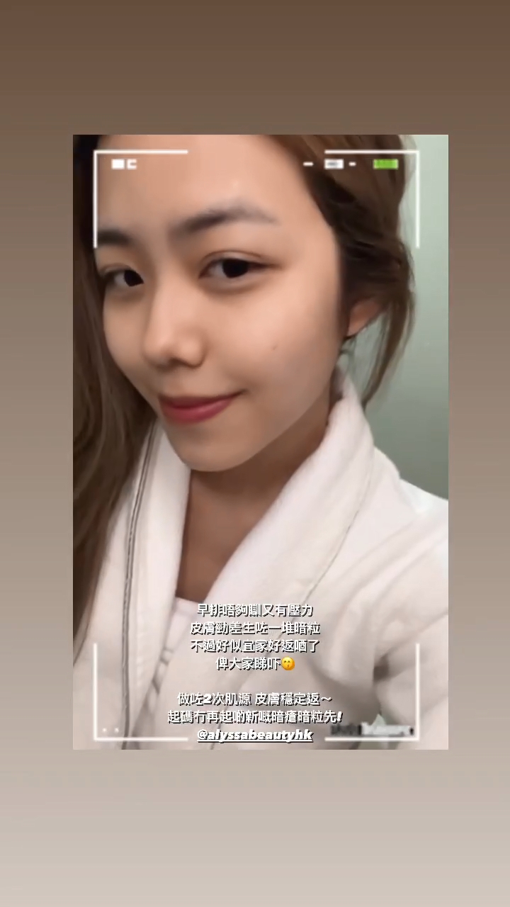 莊子璇前日在IG Story大呼壓力大長痘痘。