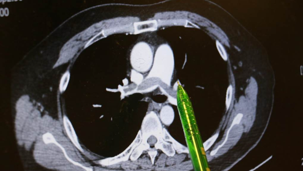 病人肺部?jī)蓚?cè)大片彌漫的血栓。