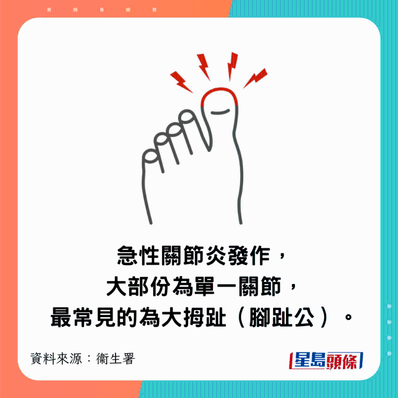 急性關(guān)節(jié)炎發(fā)作，大部份為單一關(guān)節(jié)，最常見的為大拇趾（腳趾公）