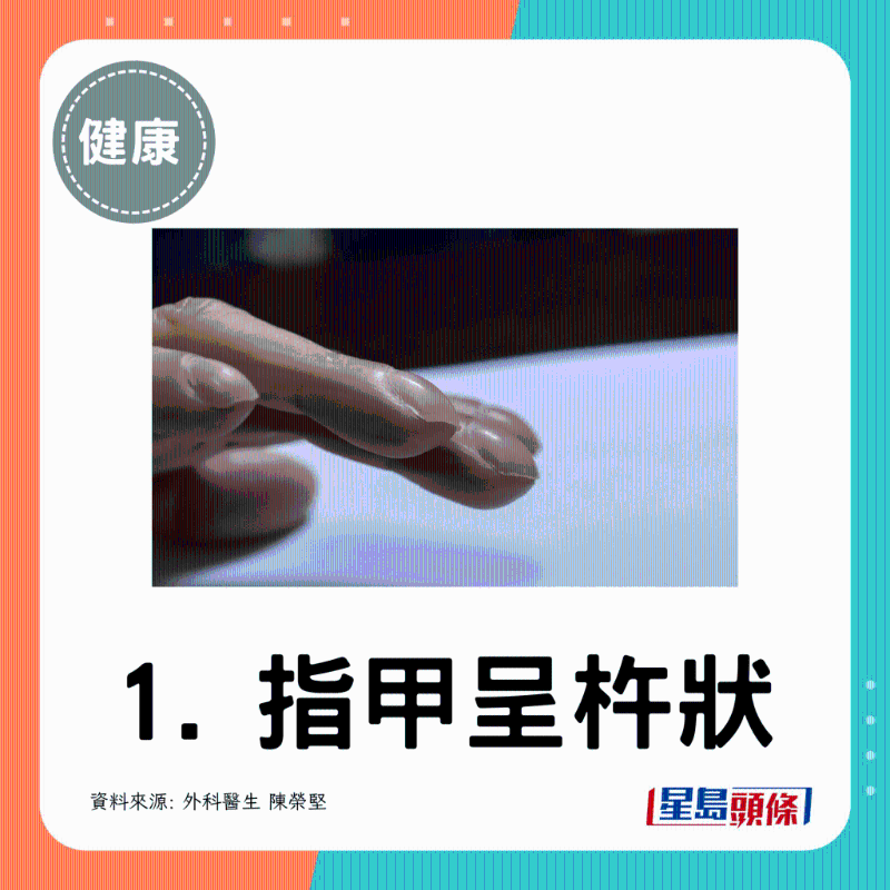 指甲呈杵狀
