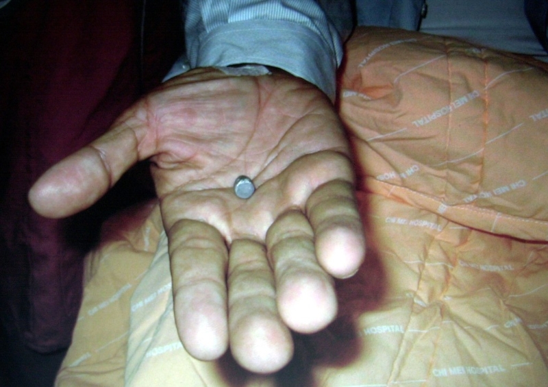 奇美醫(yī)院發(fā)布照片，展示陳水扁身體和衣服之間發(fā)現(xiàn)的彈頭。美聯(lián)社