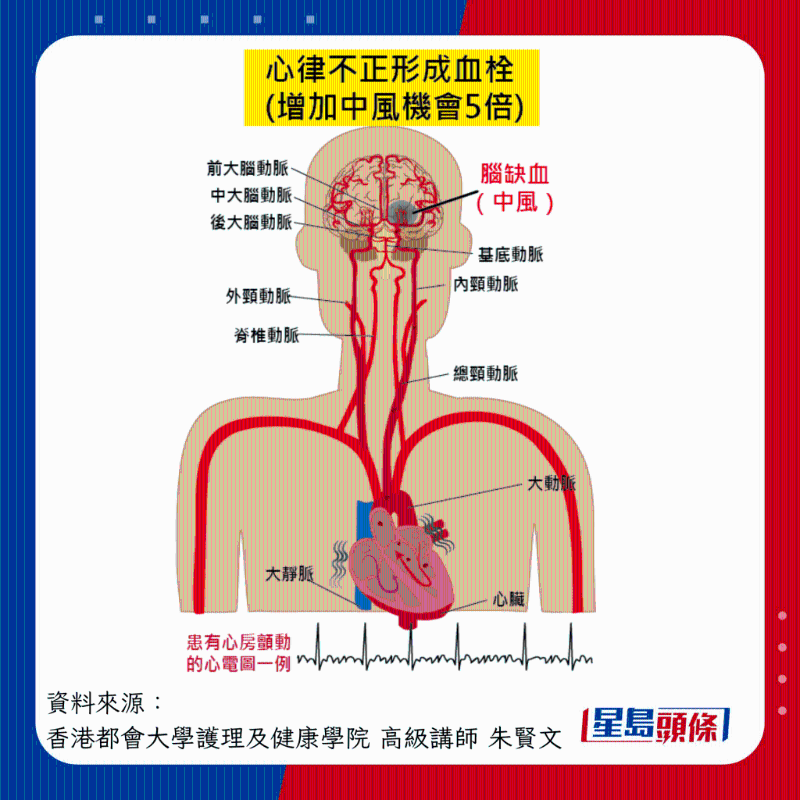 心率不正增加中風(fēng)風(fēng)險(xiǎn)
