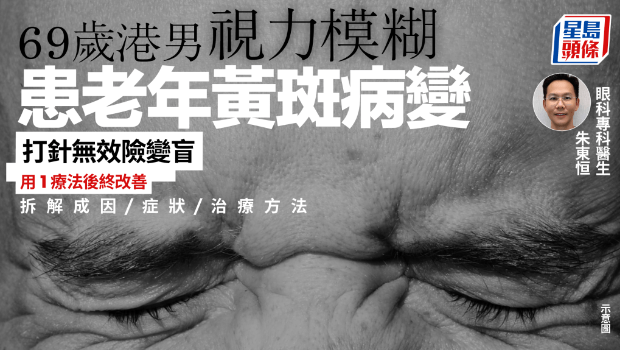 69歲港男視力模糊