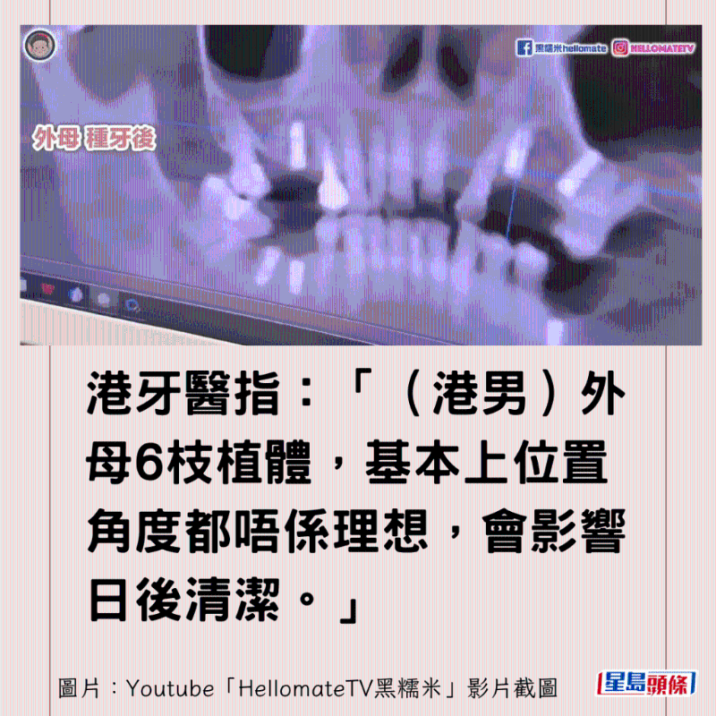 港牙醫(yī)指深圳牙醫(yī)犯三大錯(cuò)4 港牙醫(yī)指深圳牙醫(yī)犯三大錯(cuò)4