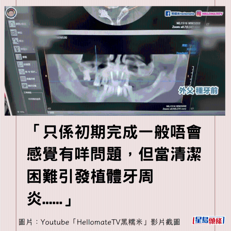 港牙醫(yī)指深圳牙醫(yī)犯三大錯(cuò)2 港牙醫(yī)指深圳牙醫(yī)犯三大錯(cuò)2