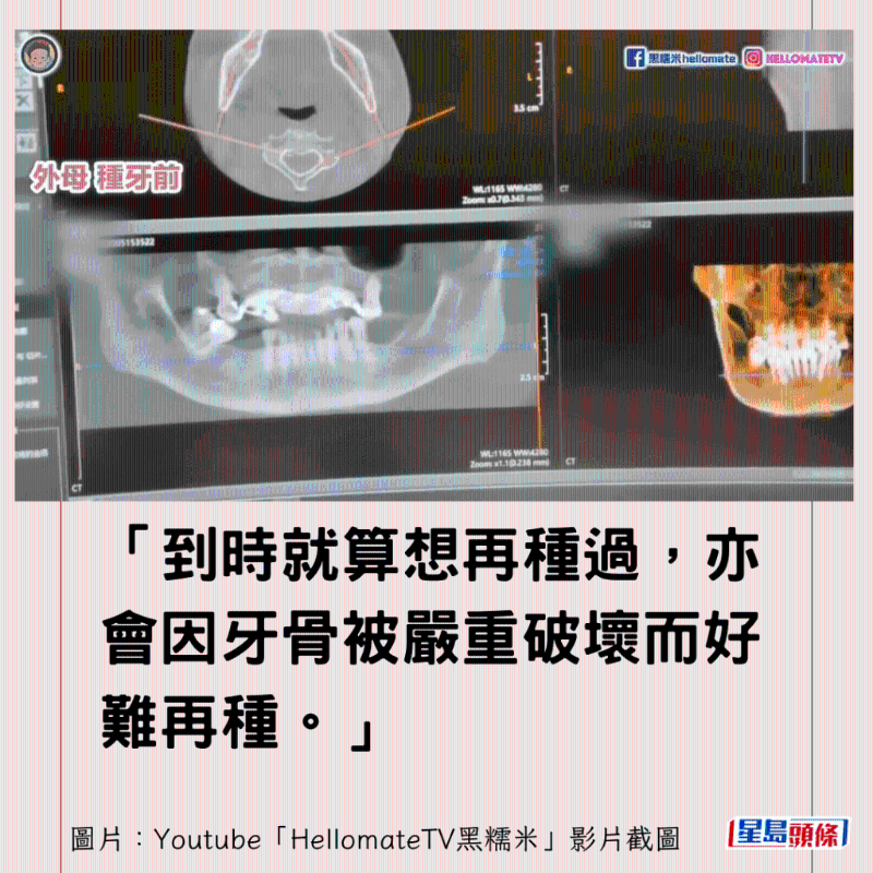 港牙醫(yī)指深圳牙醫(yī)犯三大錯(cuò)1 港牙醫(yī)指深圳牙醫(yī)犯三大錯(cuò)1