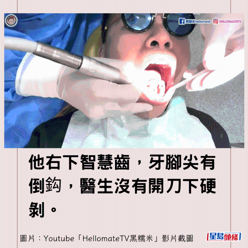 香港男子實(shí)測(cè)深圳平價(jià)洗牙種牙15 香港男子實(shí)測(cè)深圳平價(jià)洗牙種牙15