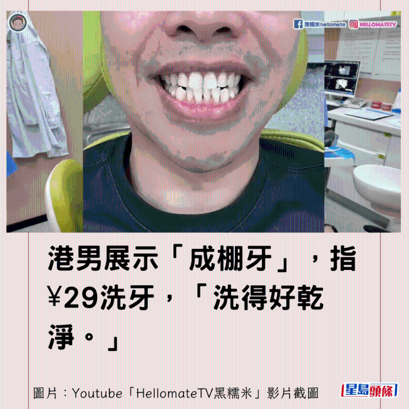 香港男子實(shí)測(cè)深圳平價(jià)洗牙種牙3 香港男子實(shí)測(cè)深圳平價(jià)洗牙種牙3