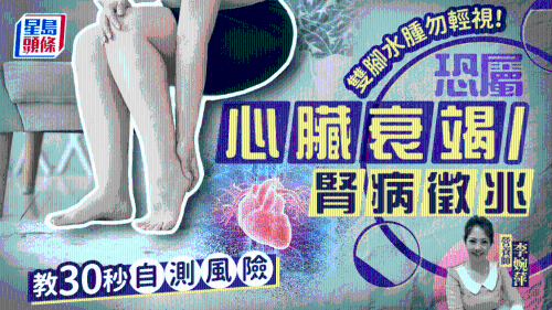 雙腳水腫勿輕視！