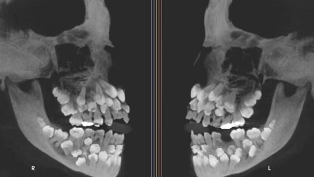 11歲女童口內(nèi)驚現(xiàn)81顆牙