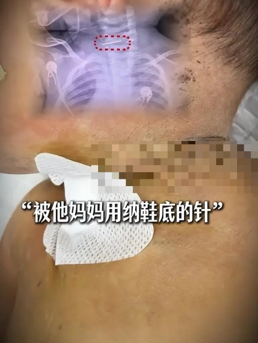 10月大男嬰慘遭扎數(shù)百針放血 10月大男嬰慘遭扎數(shù)百針放血