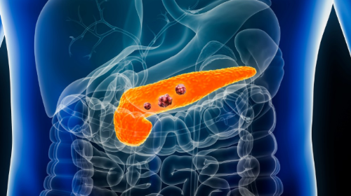 胰臟癌治療現(xiàn)重大突破！