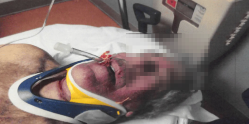 照片顯示，愛潑斯坦臉部紅腫，脖子上有勒痕